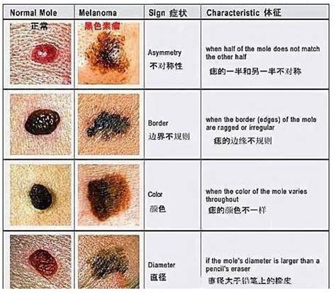 腰側有痣|腰上有這顆痣的人天生財運佳，命里藏金，家財萬貫